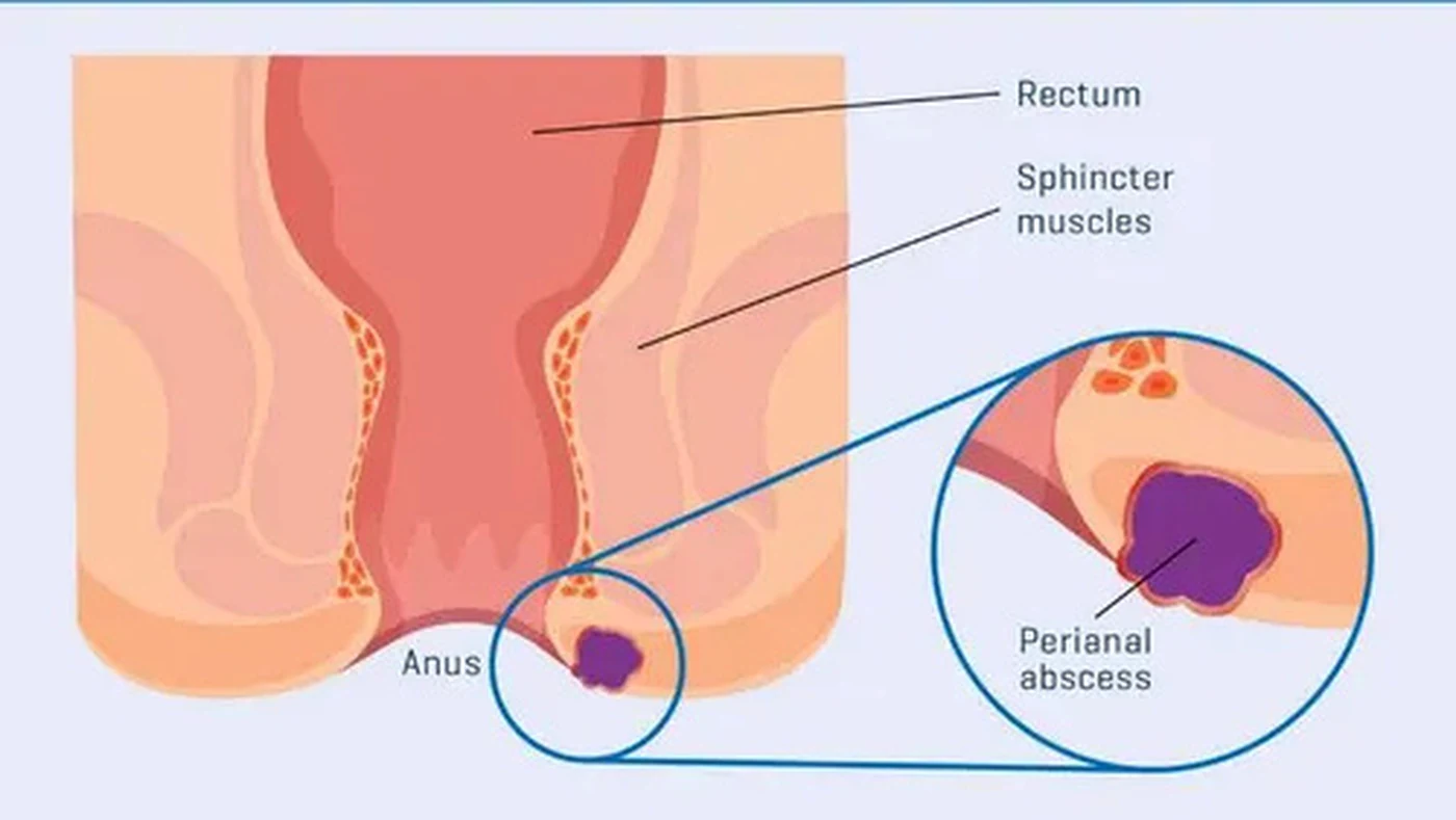 Anal / Perianal Abscess Care visual from client-provided treatment material
