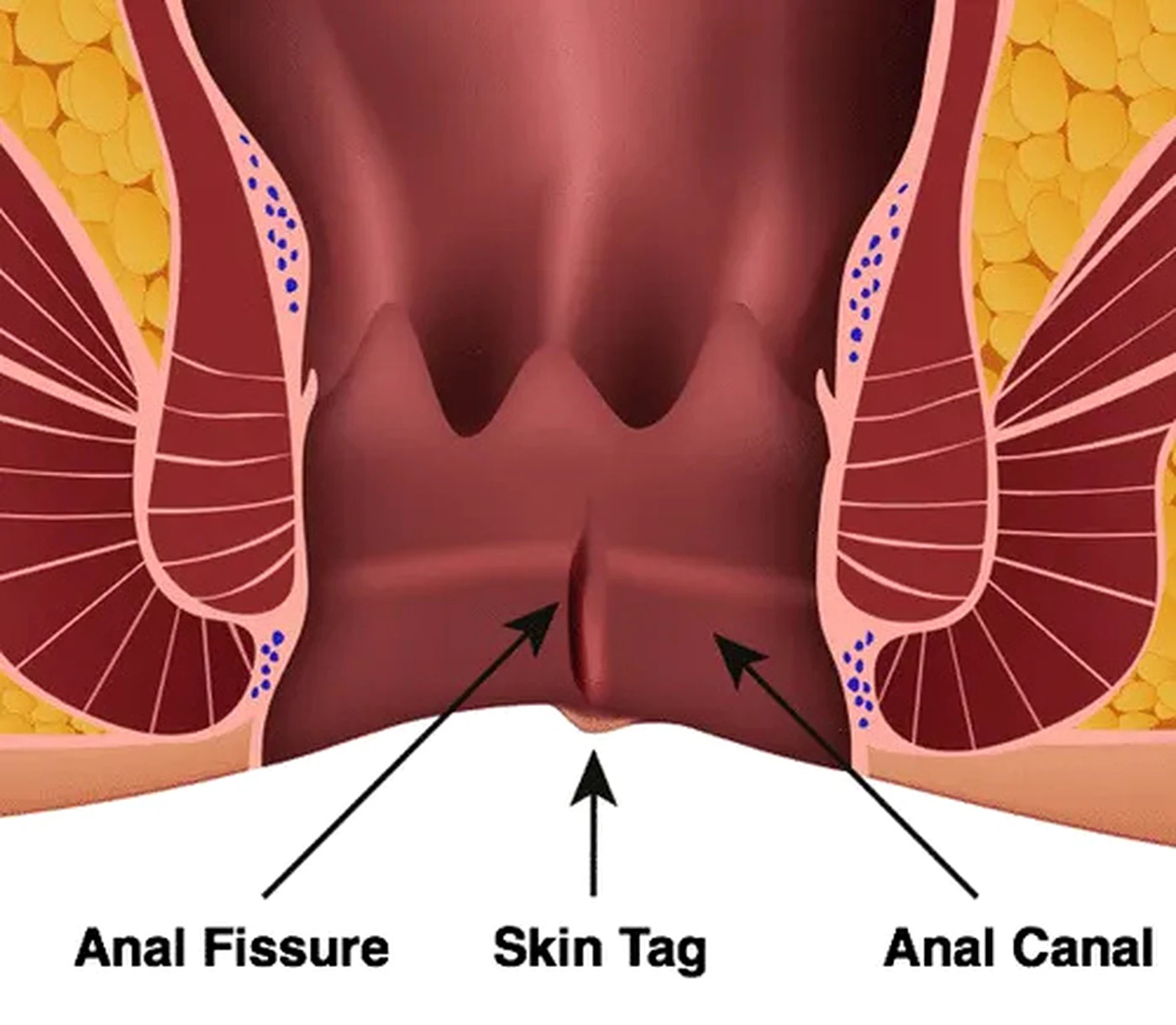 Anal Fissure Treatment illustration from client-provided treatment material