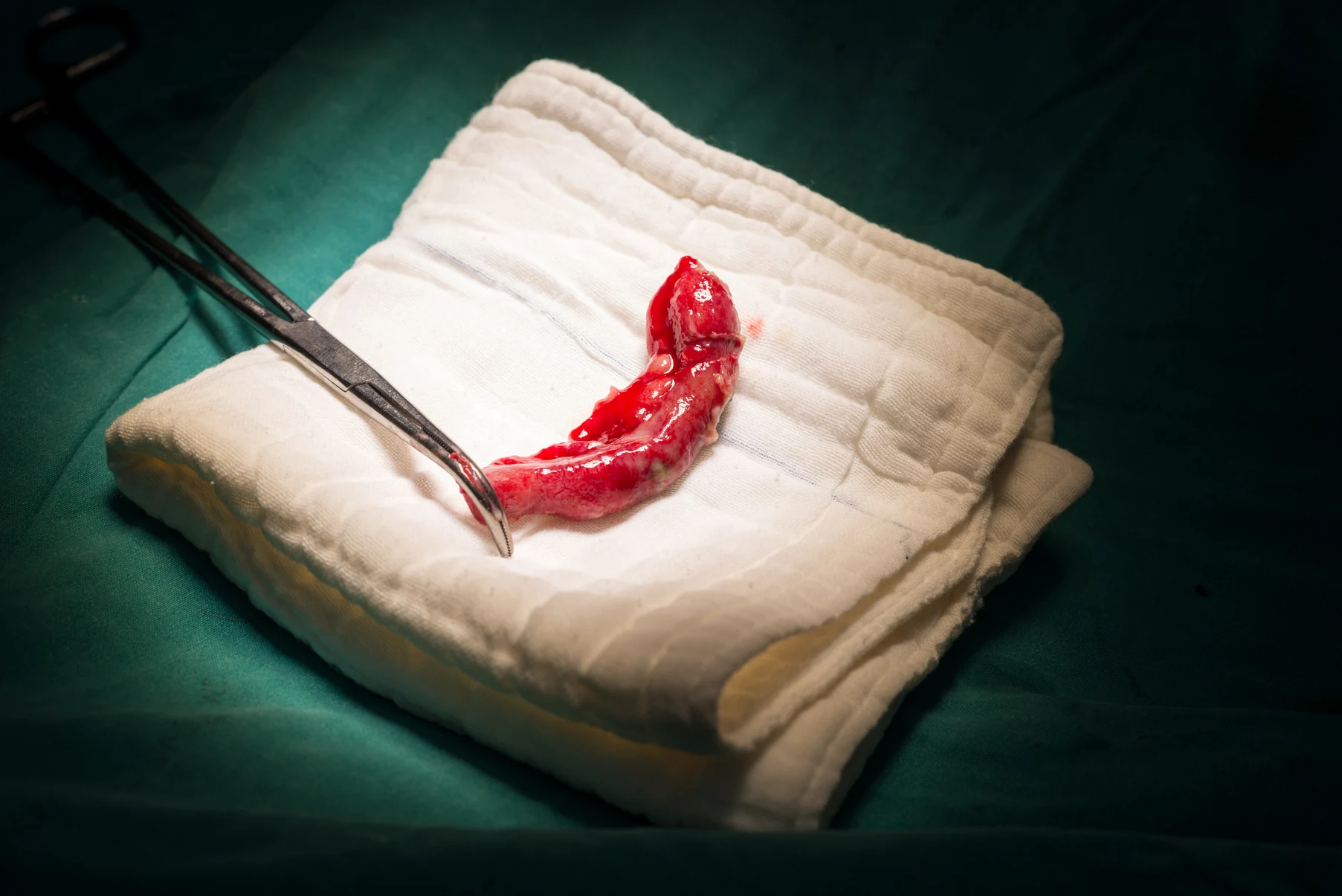 Appendix Surgery illustration from client-provided treatment material