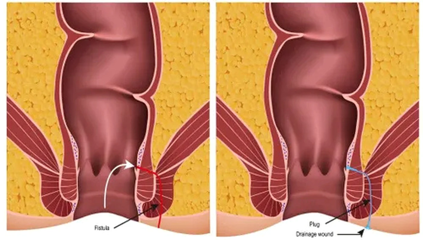 Fistula Treatment illustration from client-provided treatment material
