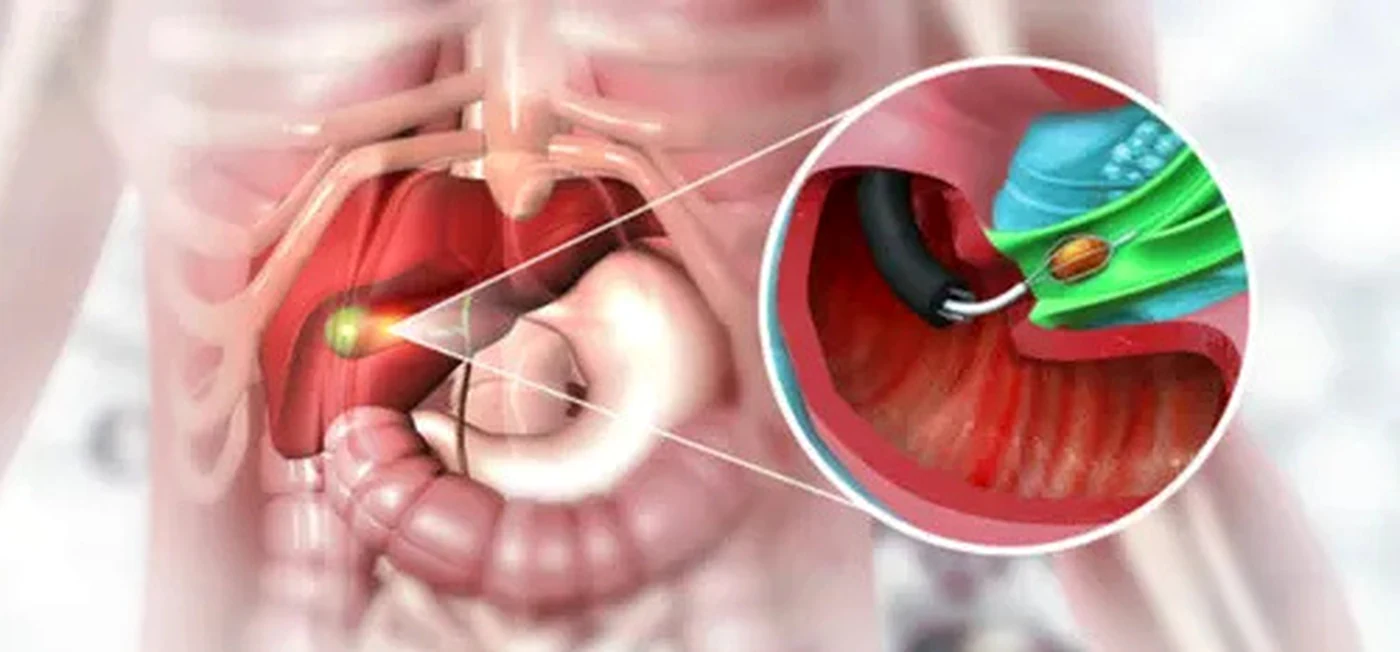 Gallbladder Stone Surgery illustration from client-provided treatment material