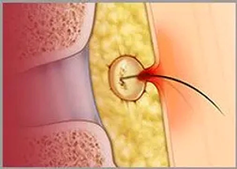 Pilonidal Sinus Treatment visual from client-provided treatment material