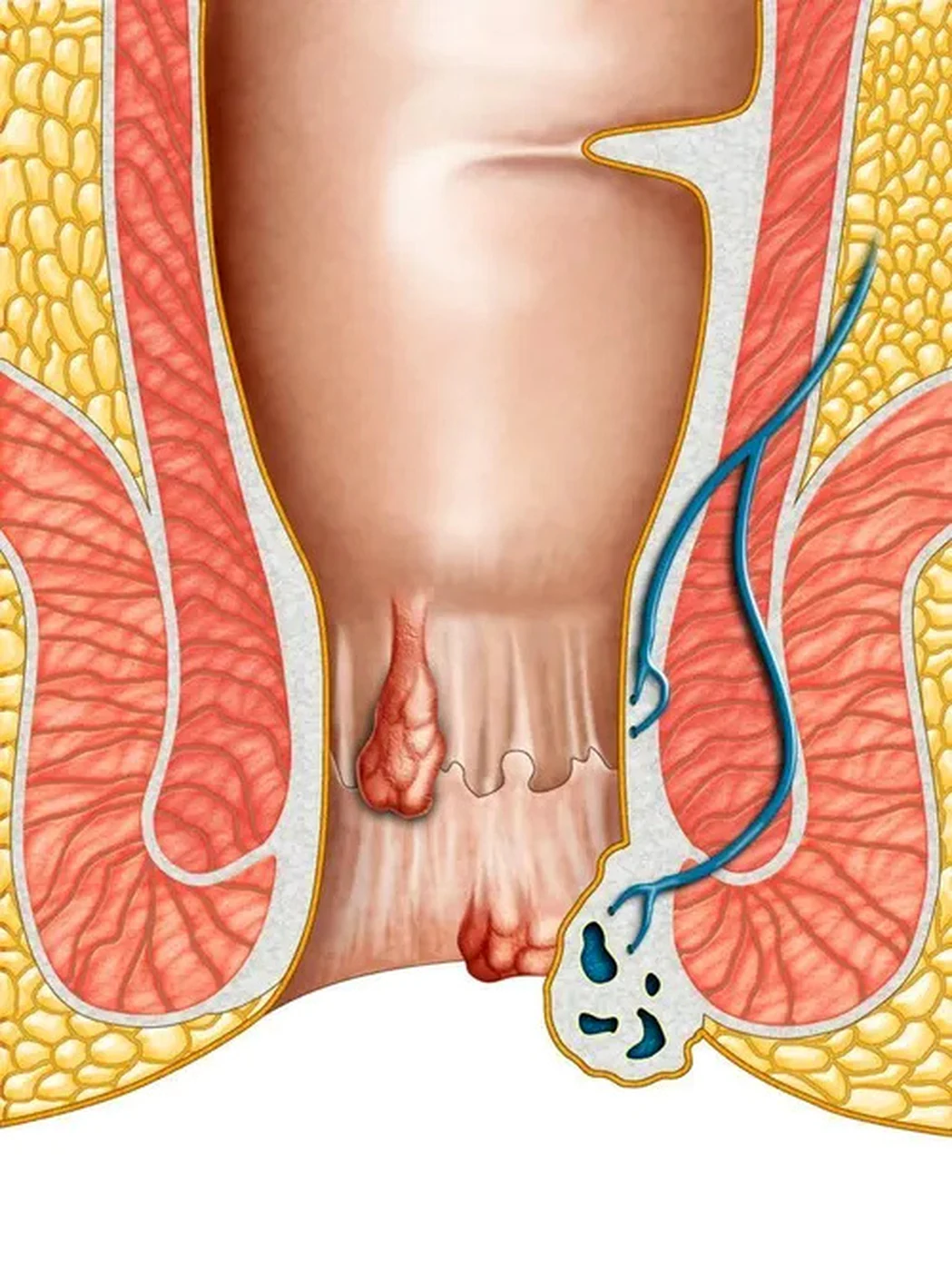 Rectal Bleeding Consultation visual from client-provided treatment material